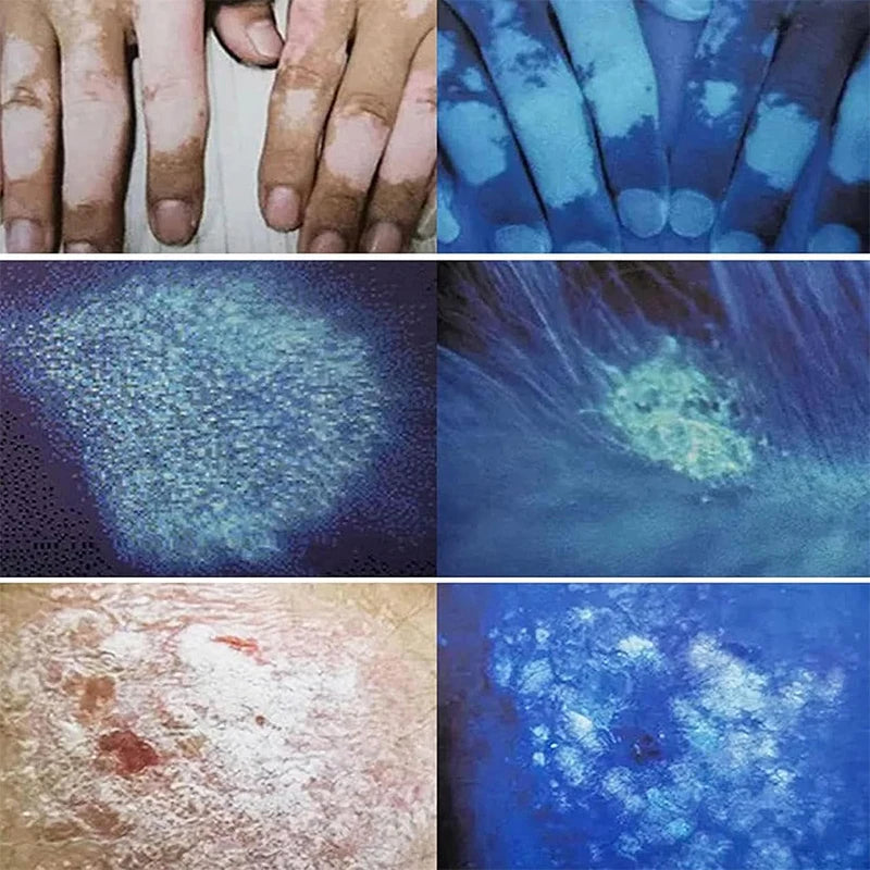 Woods Lamp Skin Analyzer Portable Facial Salon Beauty Analyzer UV Handheld Lamp for Pet Cat and Dog Skin Detection Skin care