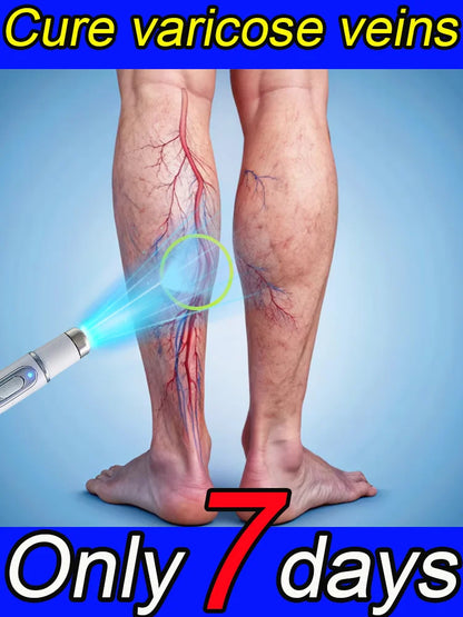 Painless removal of varicose veins, phlebitis, spider legs, prevent varicose veins, promote blood circulation