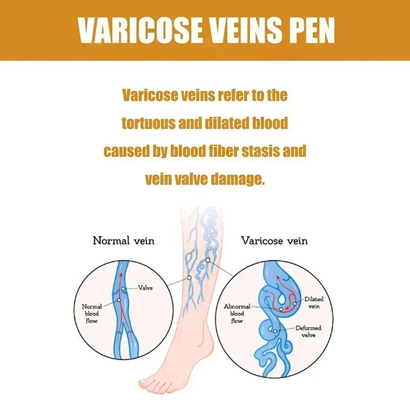 Blue light therapy for varicose veins in the legs, leg care tools